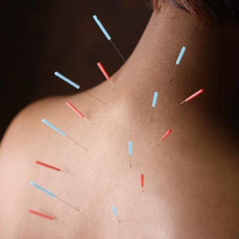 acupuncture chiropractic naturally carrollwood fl